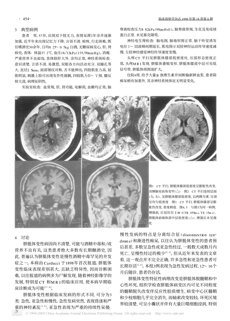 胼胝体变性的CT和MRI分析_第2页