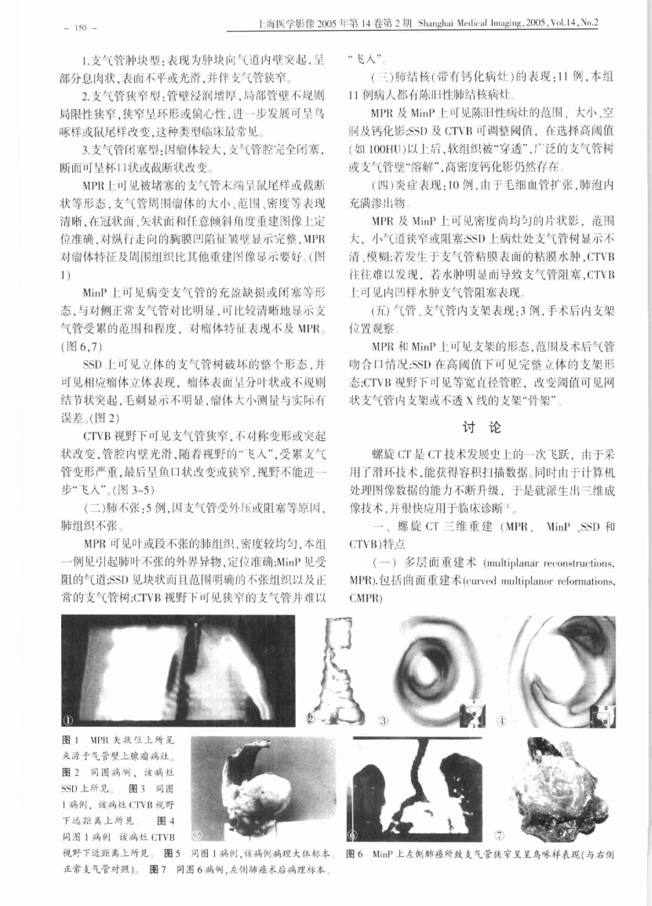 螺旋CT三维重建在诊断气管,支气管病变的应用_第2页