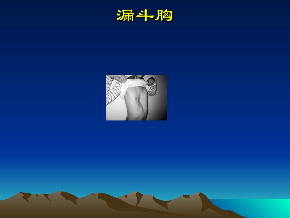 漏斗胸 ppt_第1页