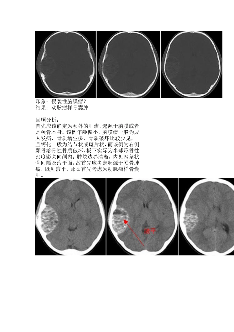 颅骨动脉瘤样骨囊肿_第2页