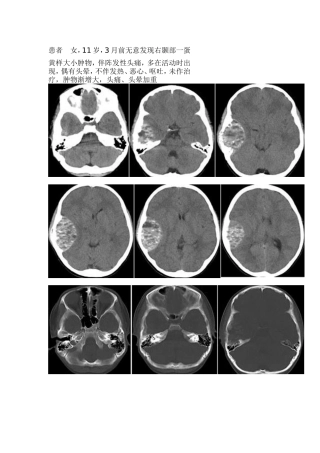 颅骨动脉瘤样骨囊肿