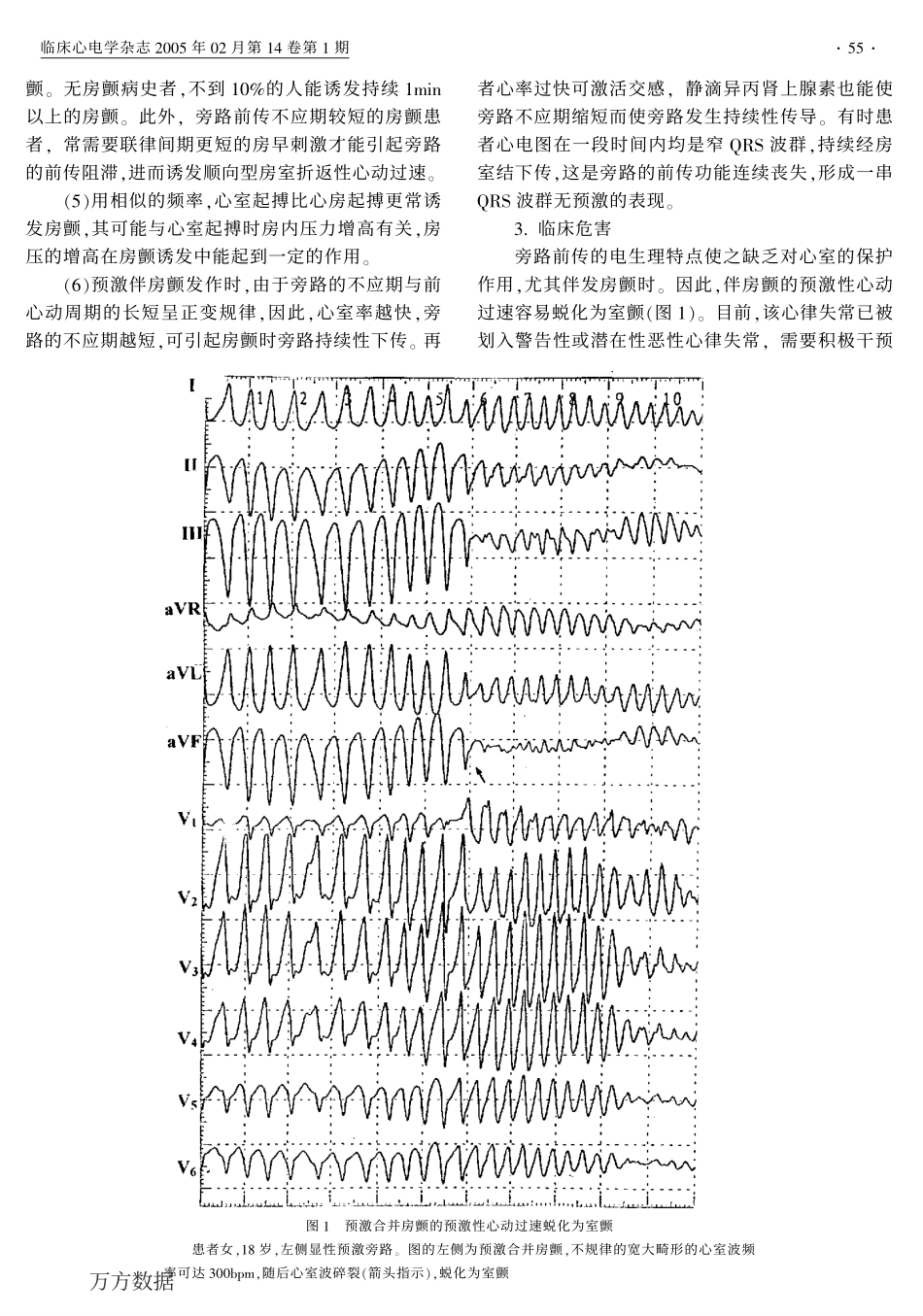 预激性心动过速_第3页