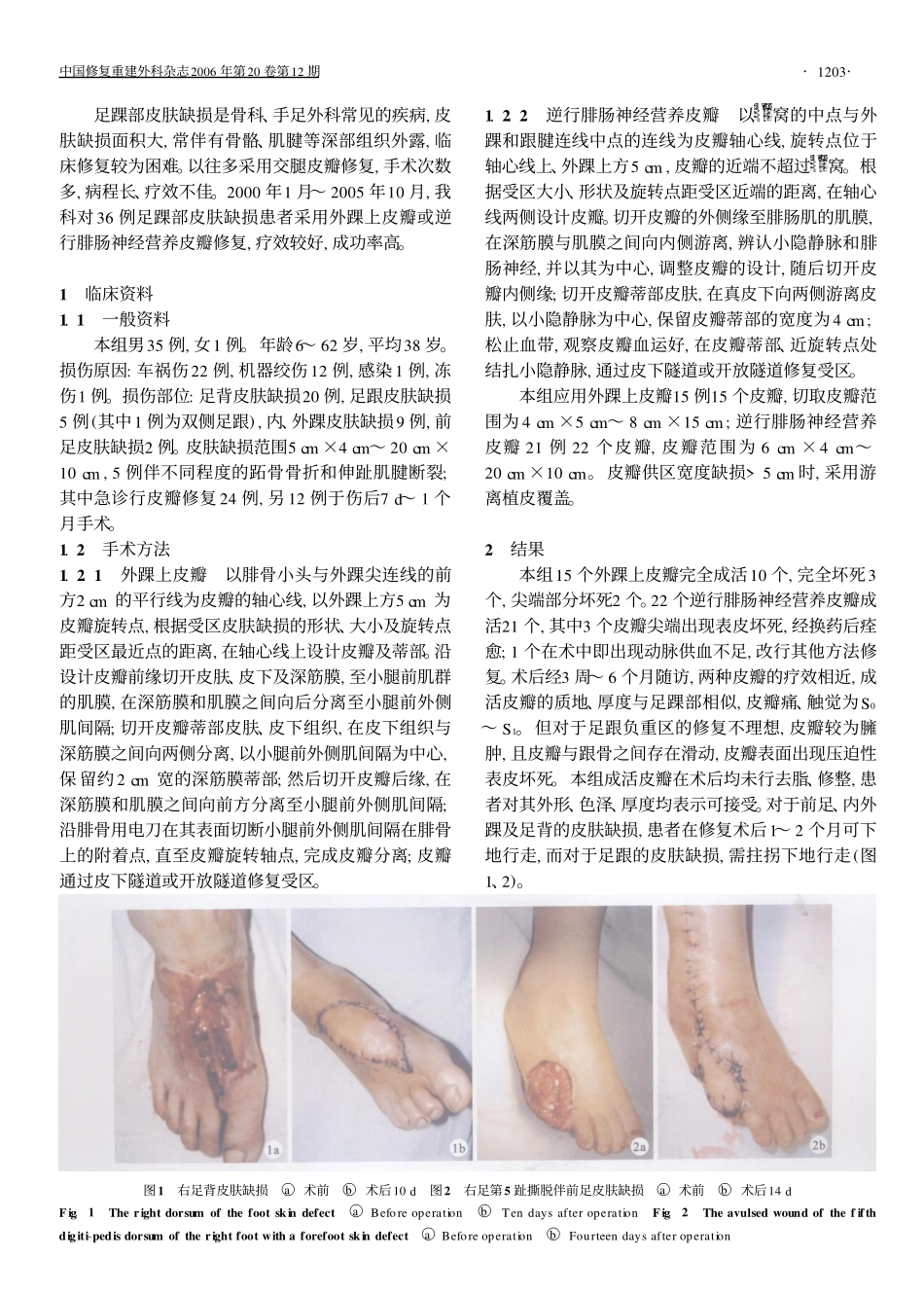 足踝部皮肤缺损的修复_第2页