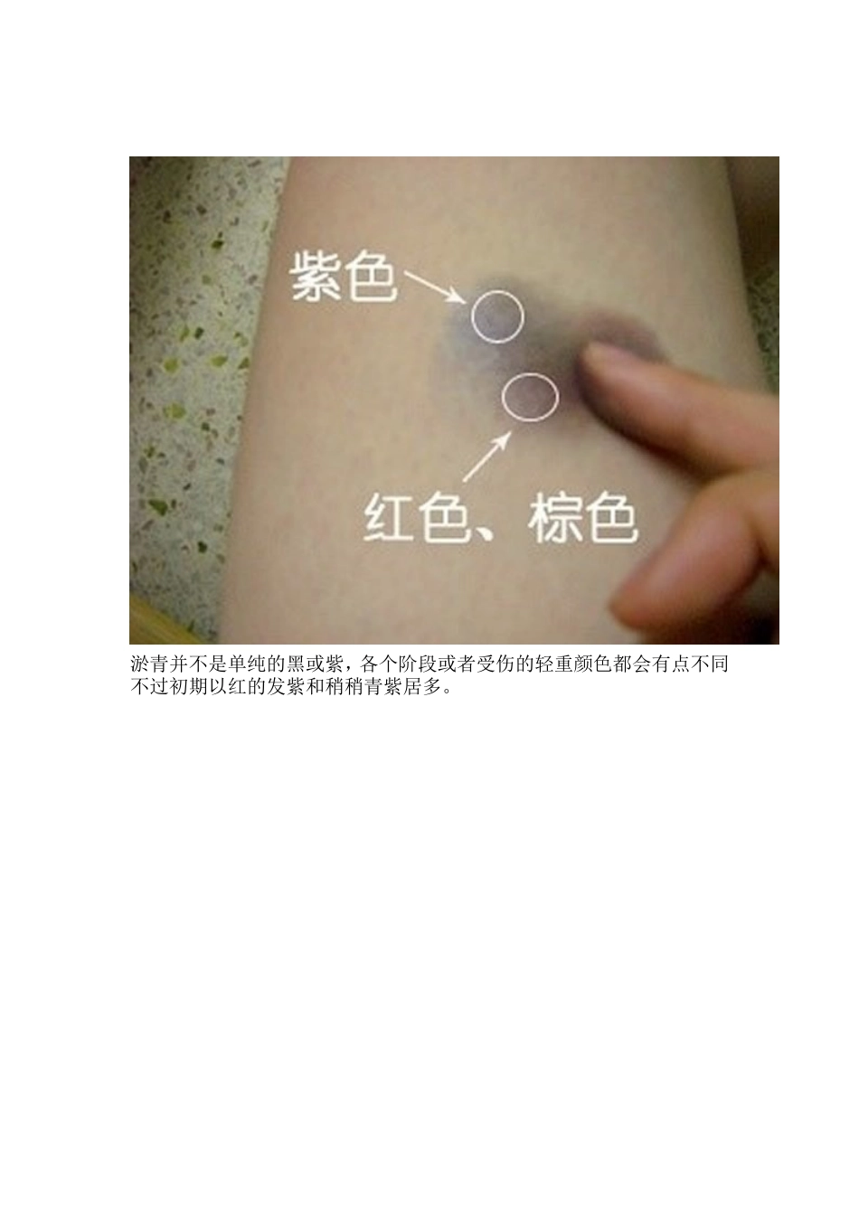 装伤请病假之必备伤口_第3页