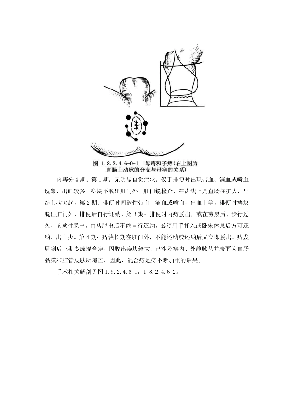 血栓性外痔摘除术_第2页