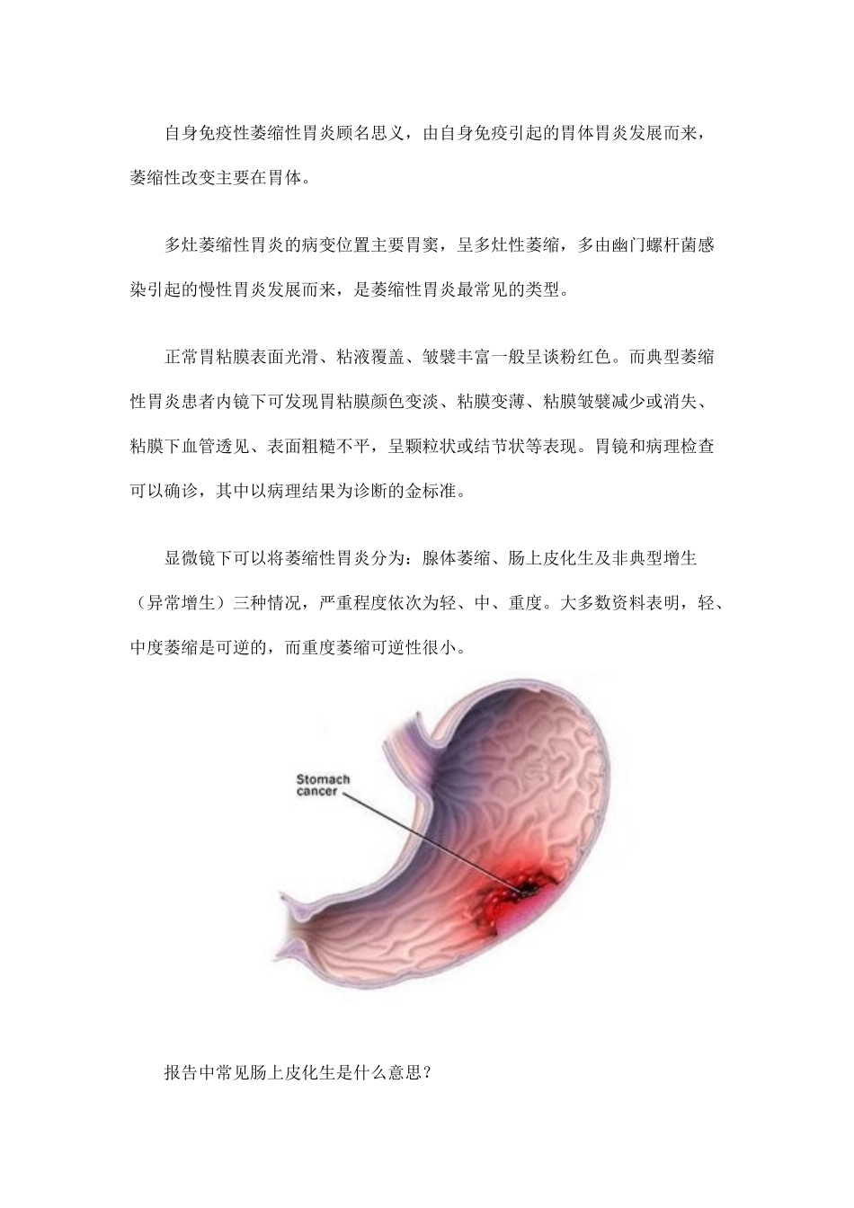 萎缩性胃炎的症状与分类_第2页