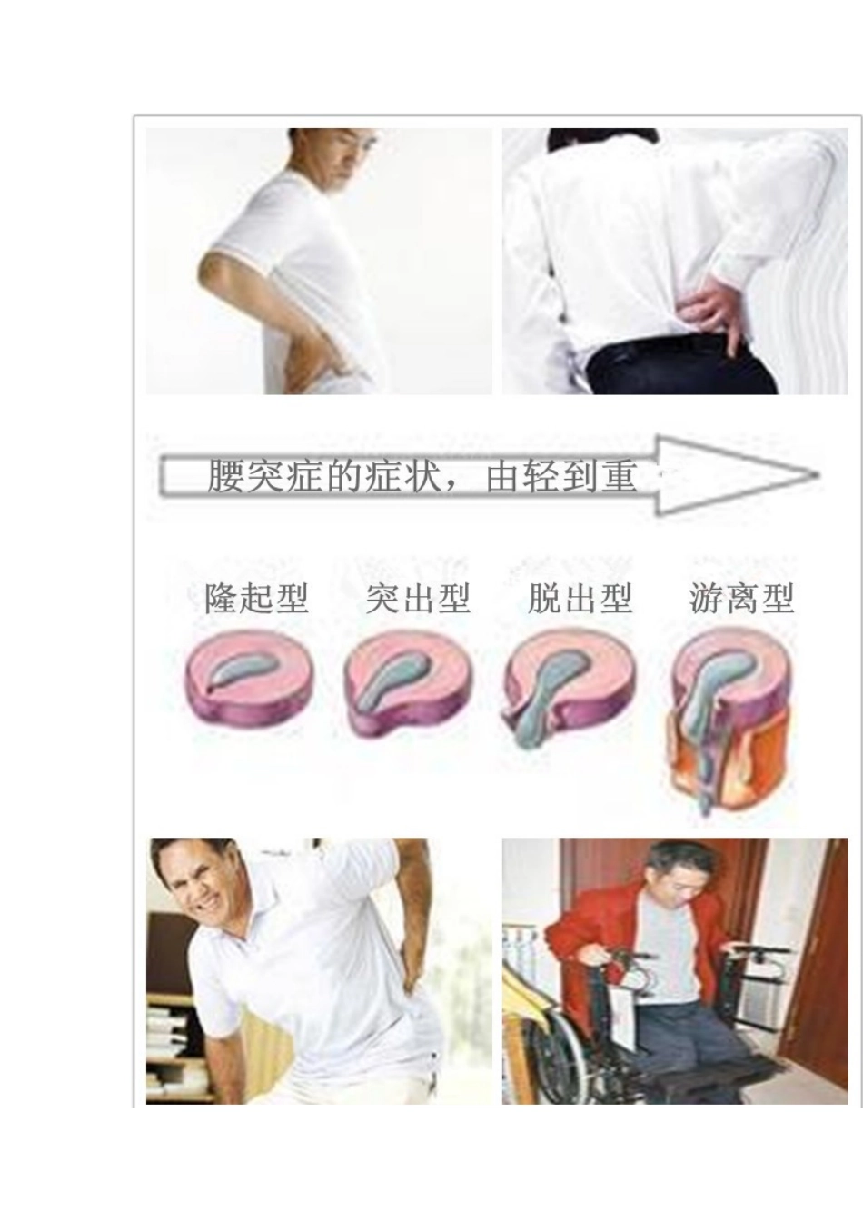 腰椎间盘突出的简介_第2页