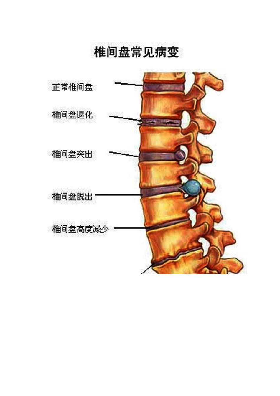 腰椎间盘突出有什么感觉_第2页