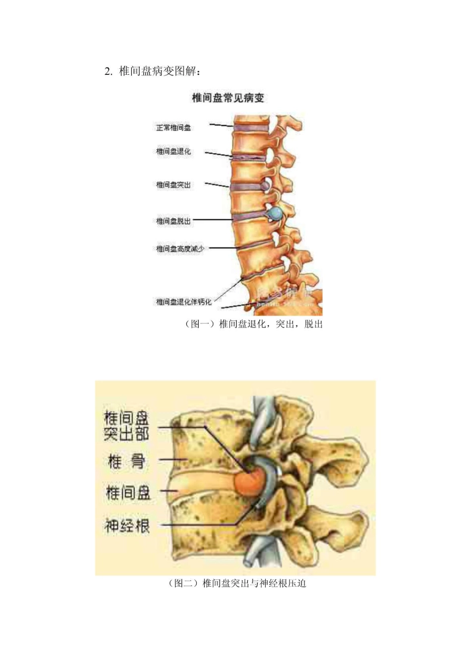 腰椎CT读片_第3页