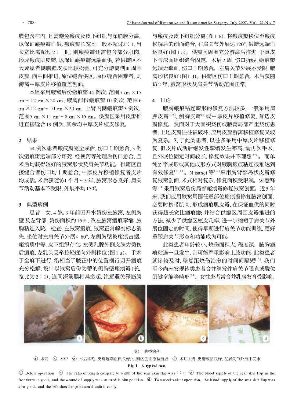 腋周瘢痕瓣修复腋胸瘢痕粘连_第2页
