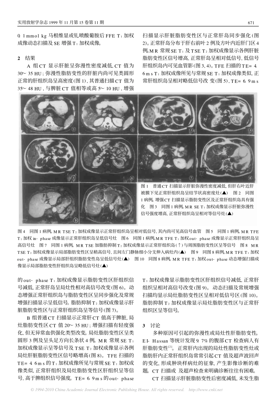 脂肪肝内正常肝岛及正常肝内局灶脂肪变性的CT与MR诊断_第2页