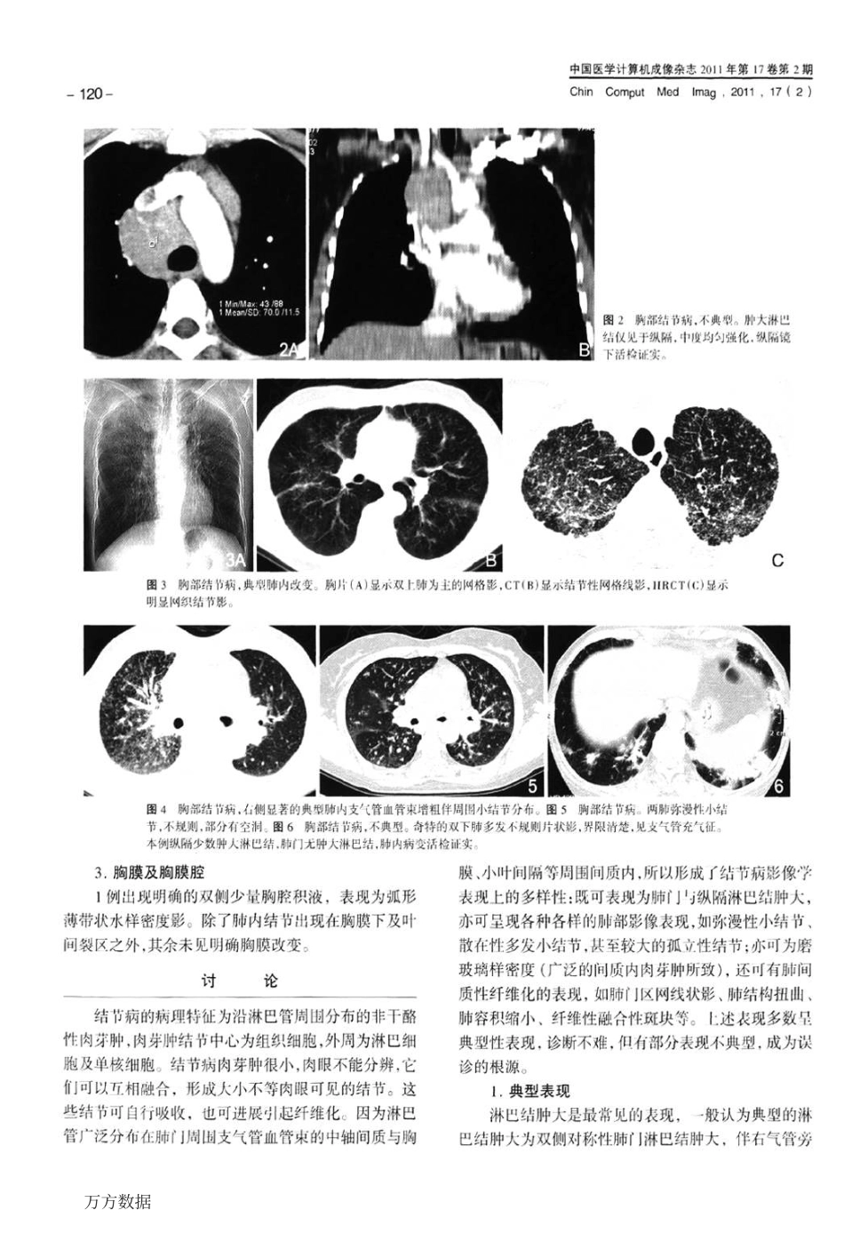 胸部结节病CT影像表现_第3页