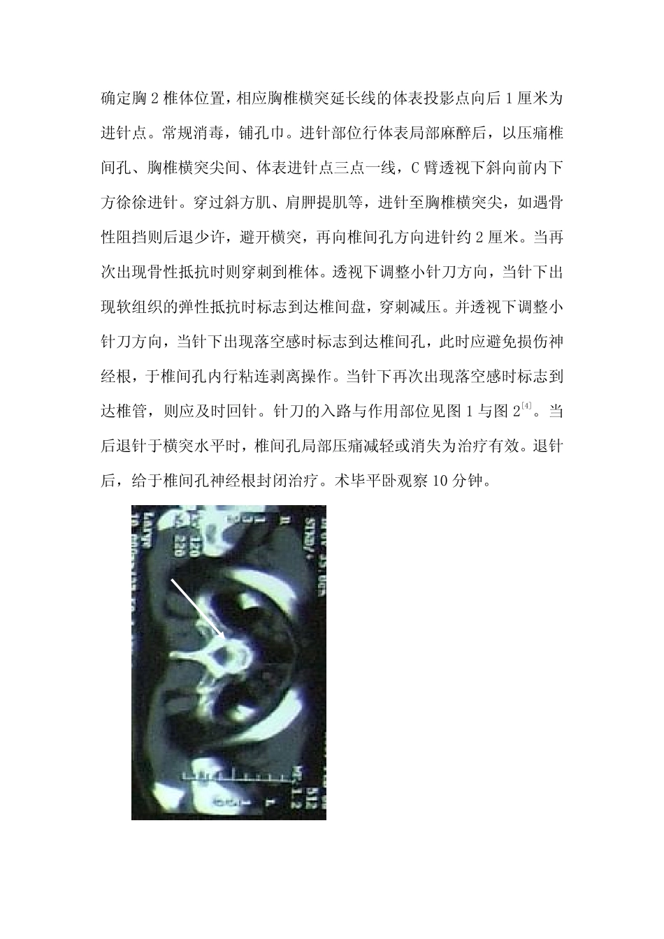 胸椎间盘突出症的小针刀治疗_第3页