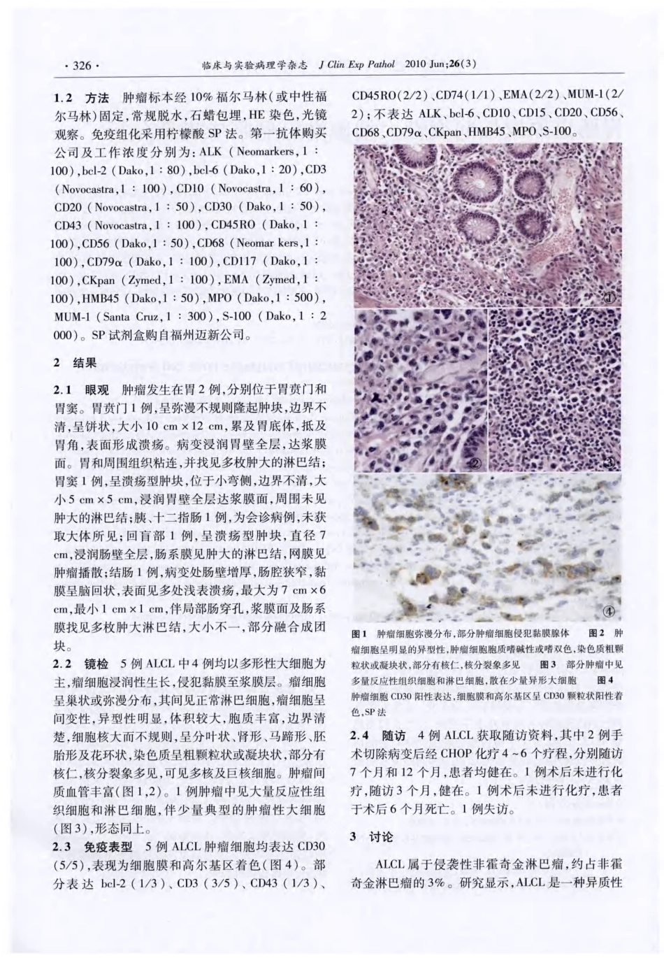胃肠道原发性间变性大细胞淋巴瘤临床病理分析_第2页