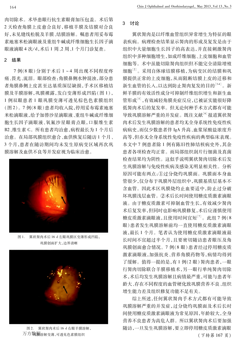 翼状胬肉术后巩膜溶解的临床观察_第2页