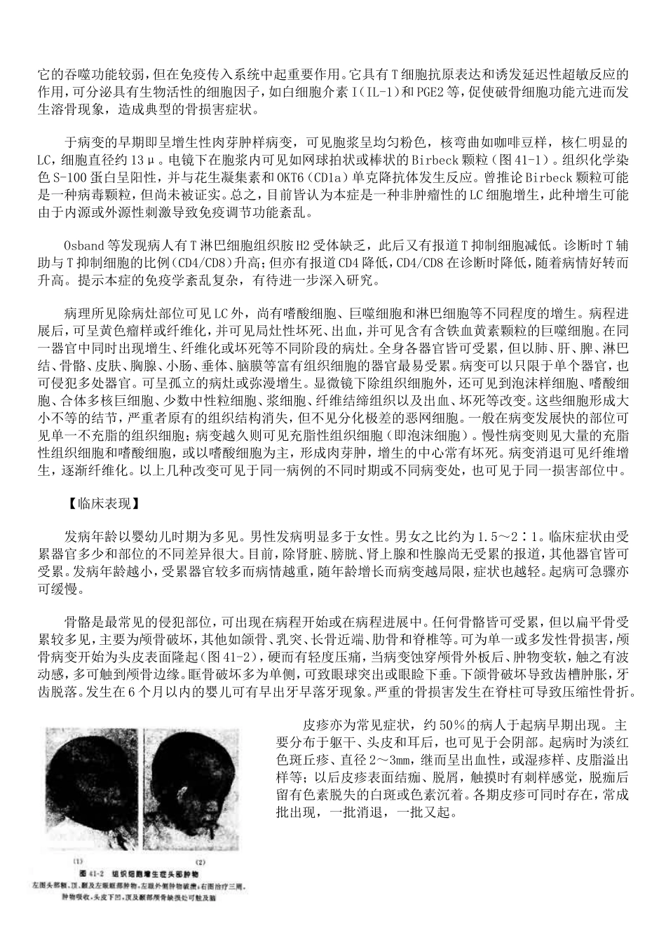 组织细胞增生症_第2页