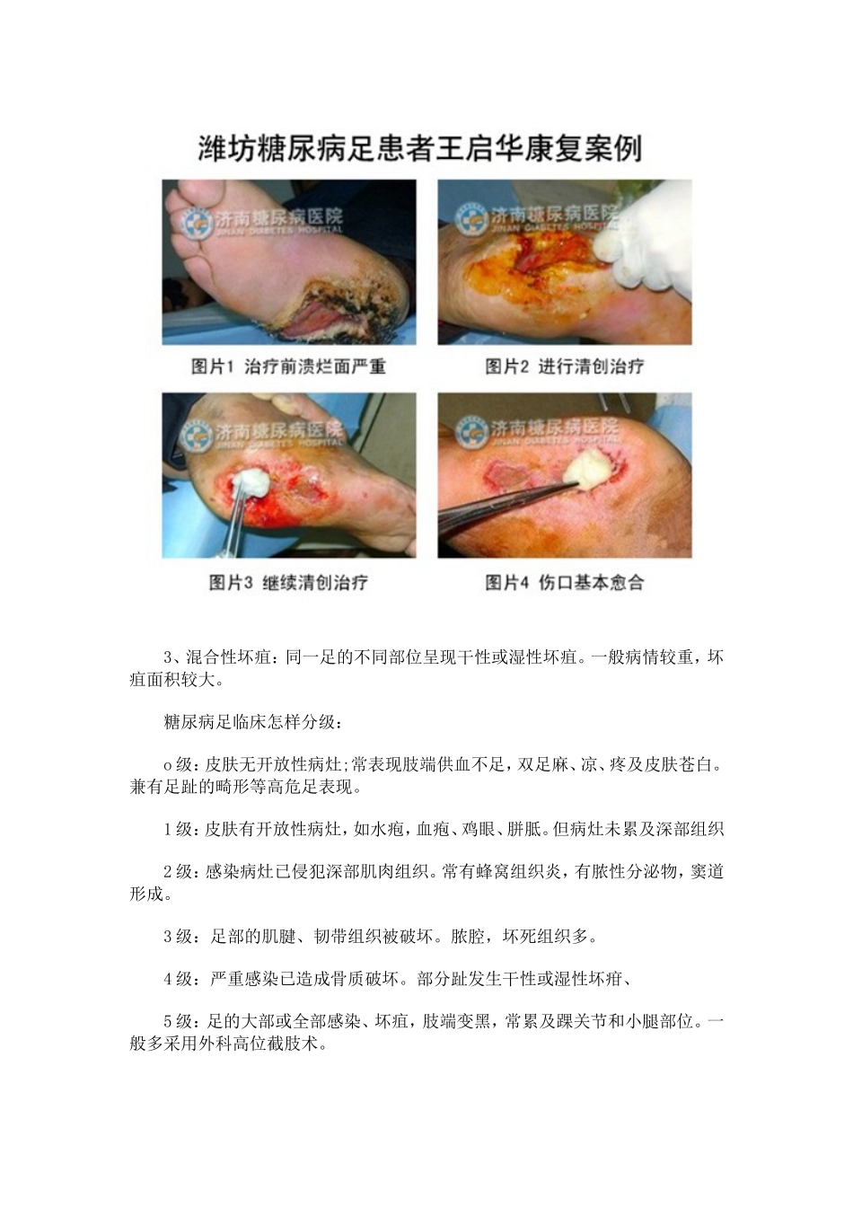 糖尿病足的症状及医治_第2页