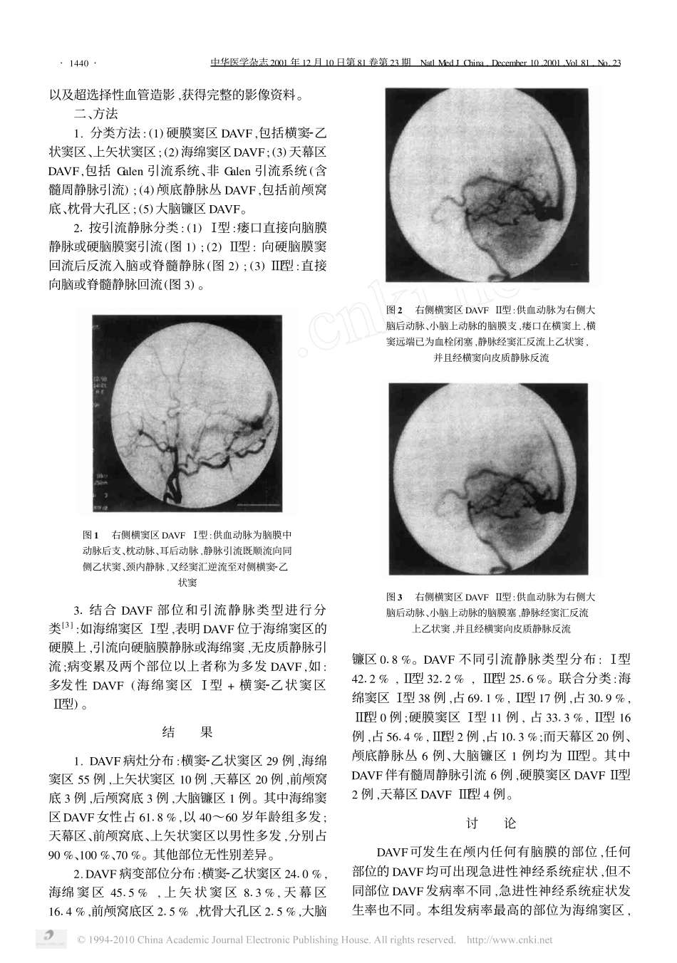 硬脑膜动静脉瘘的分型及临床意义_第2页