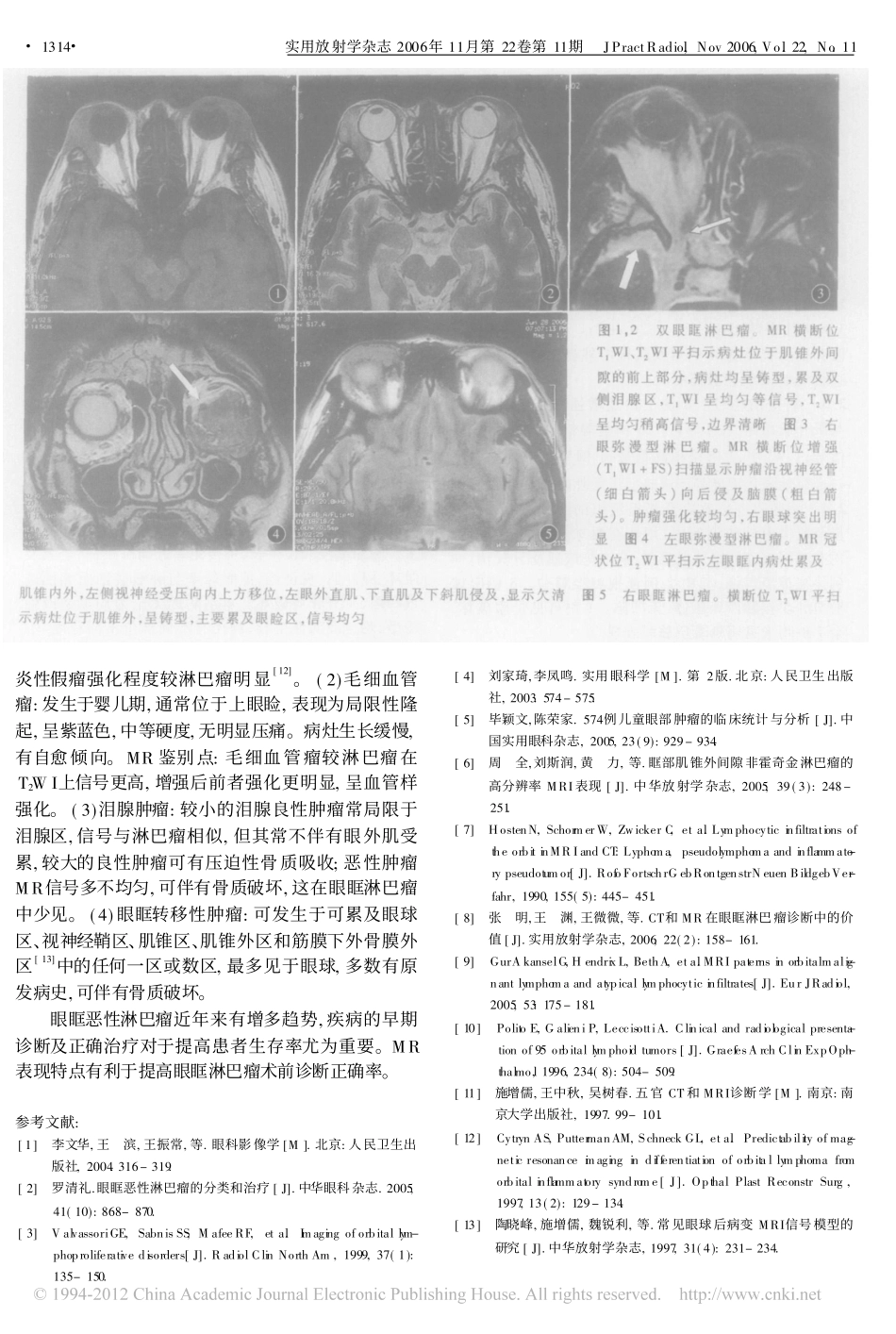 眼眶淋巴瘤的MR影像特点 - 副本_第3页