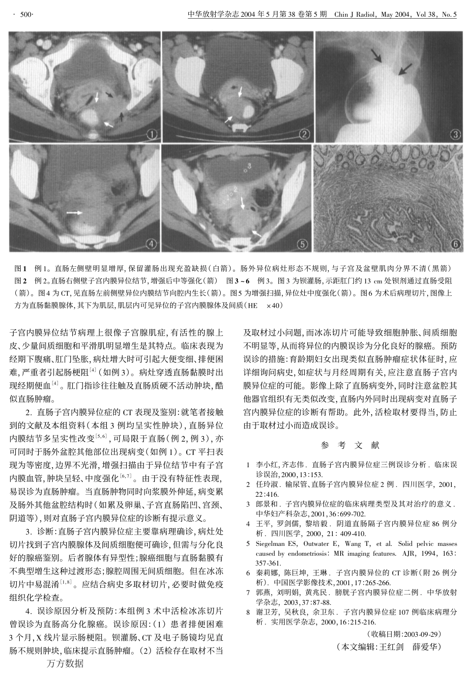 直肠子宫内膜异位症的CT表现_第2页
