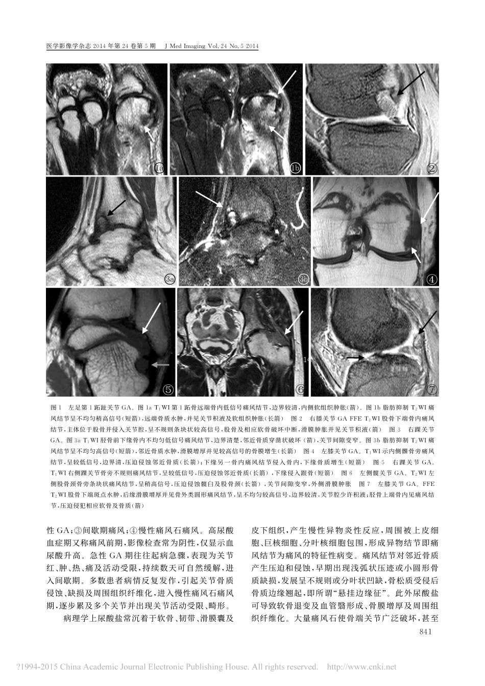 痛风性关节炎_MRI表现及临床分析_第3页