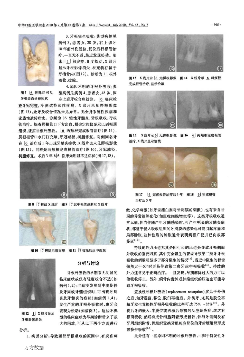 牙根外吸收四例病例分析_第2页