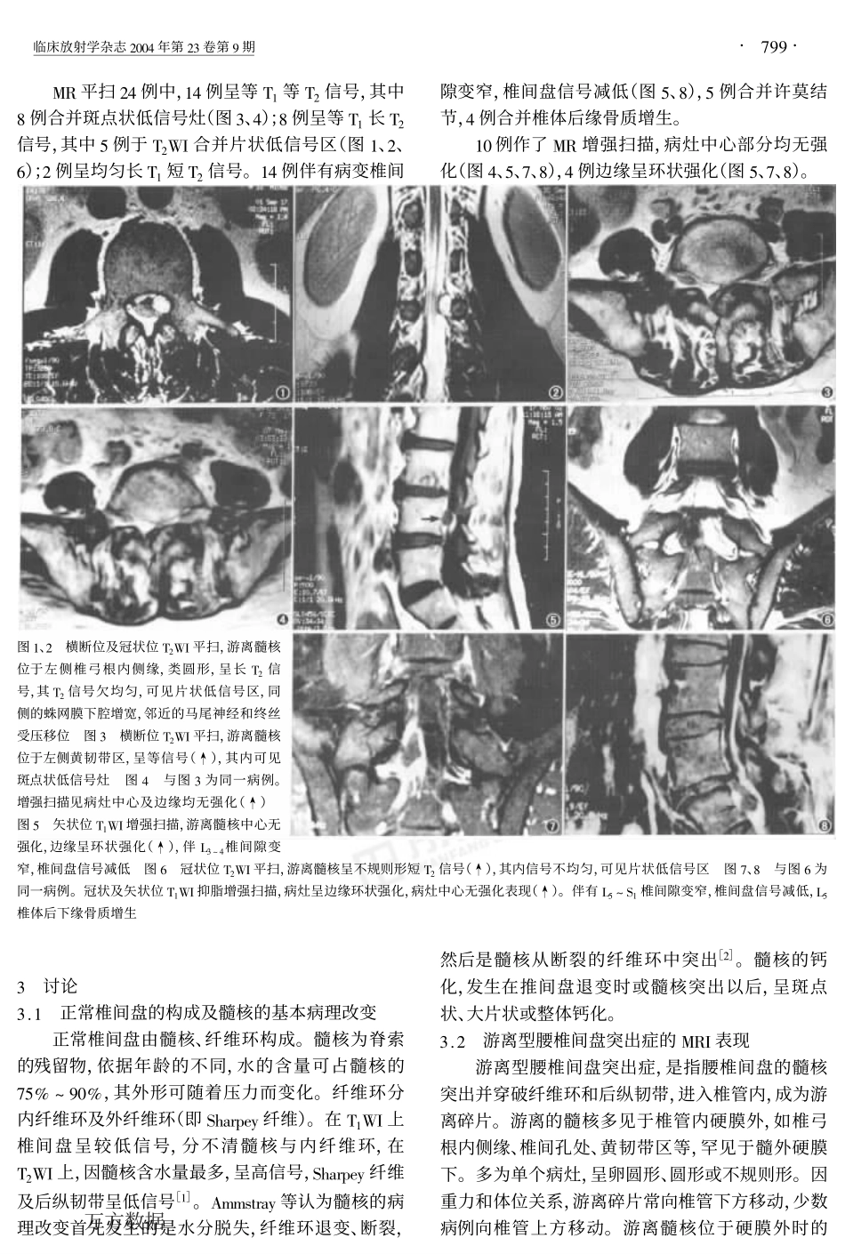 游离型腰椎间盘突出的MRI表现_第2页