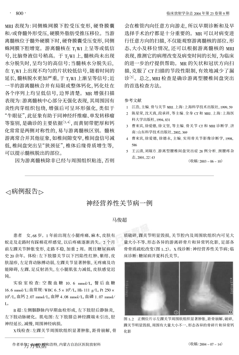 游离型腰椎间盘突出的MRI表现_第3页