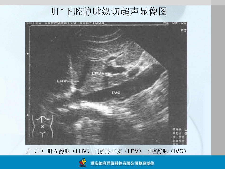 正常肝脏B超解剖图谱_第3页