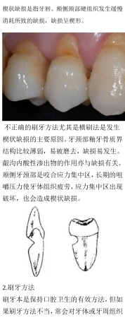 楔状缺损与正确刷牙方法@社区卫生教育