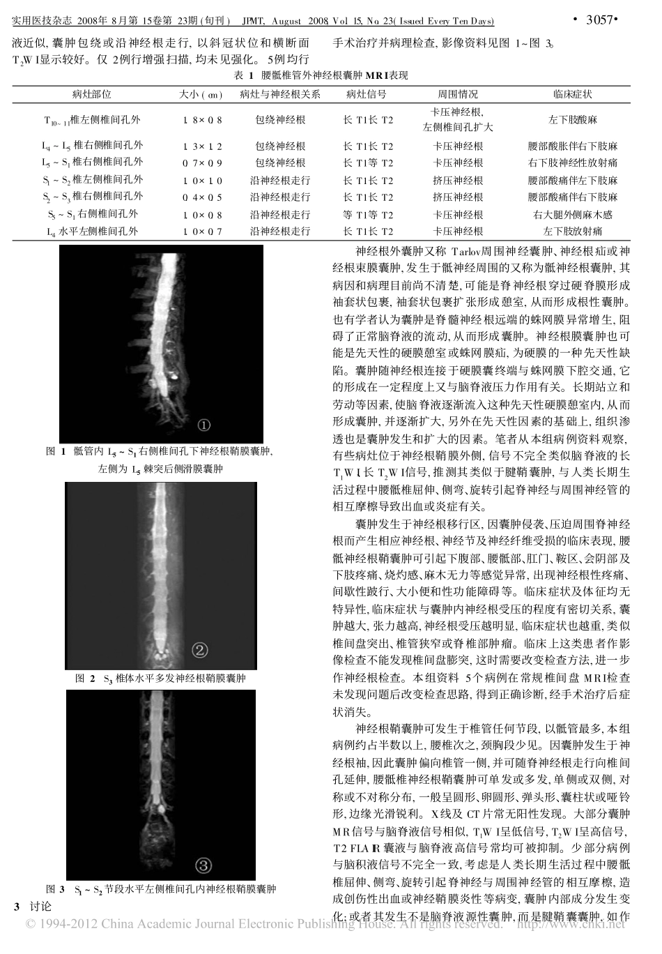 椎管外神经根囊肿MRI检查_第2页
