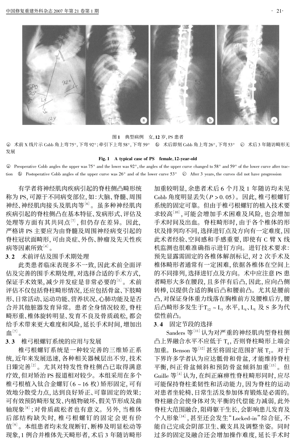 椎弓根螺钉-棒系统矫治麻痹性脊柱侧凸_第3页