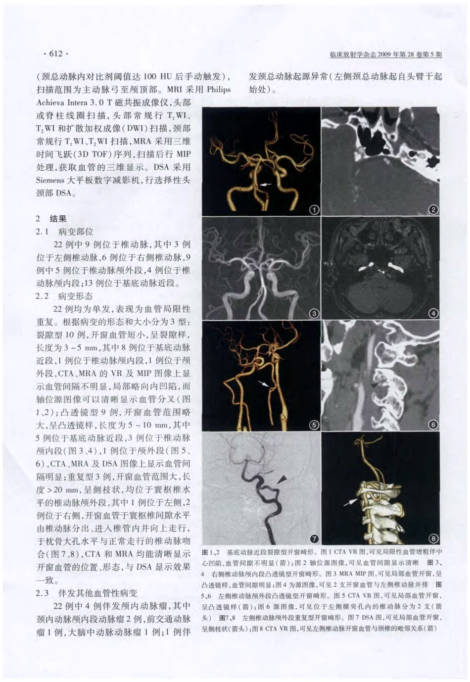 椎基底动脉开窗畸形的CTA和MRA诊断_第2页