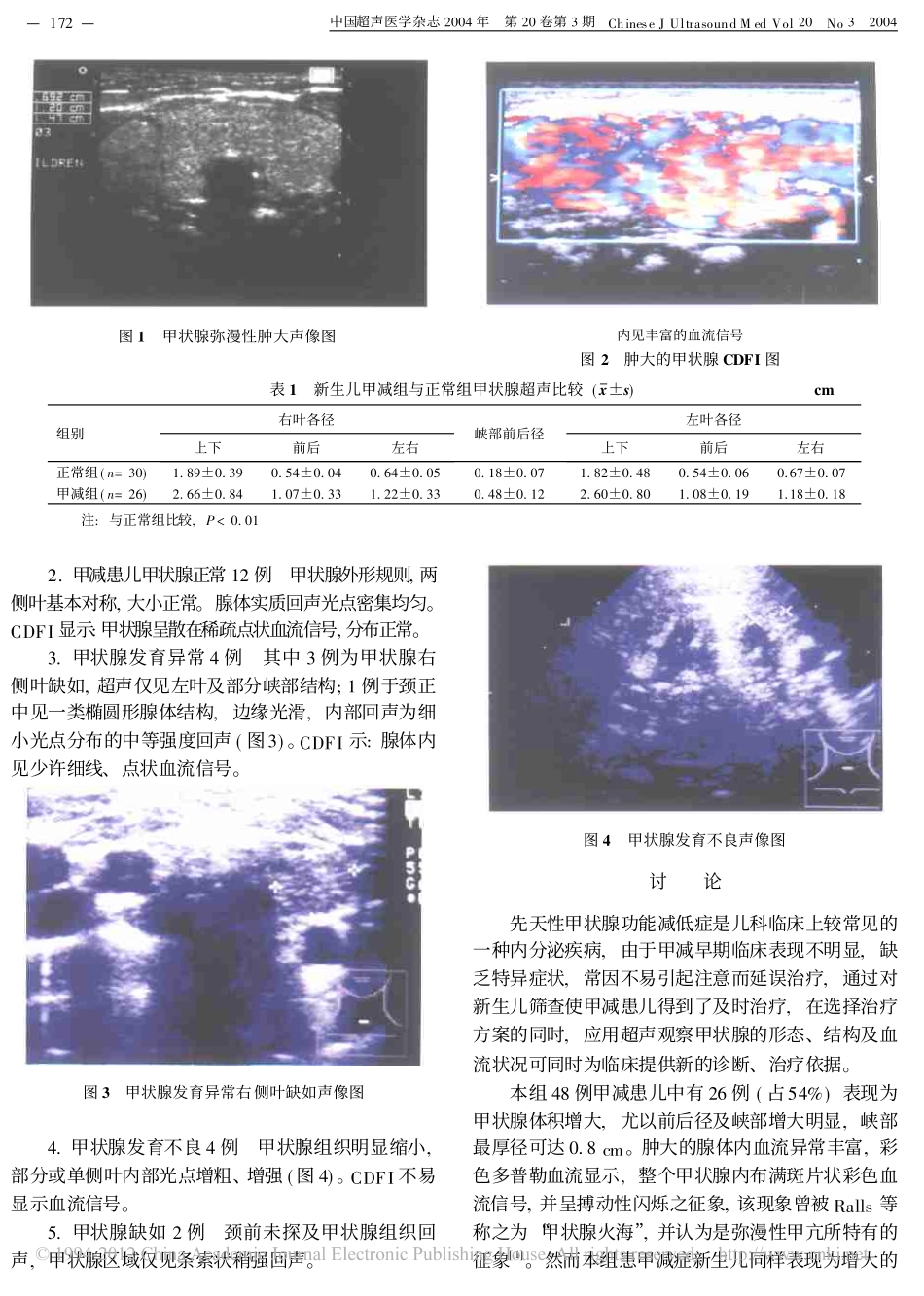 新生儿甲状腺功能减低症的超声诊断意义_赵亚平_第2页