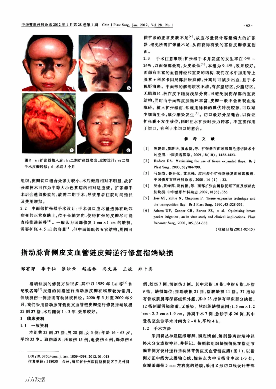 指动脉背侧皮支血管链皮瓣逆行修复指端缺损_第1页