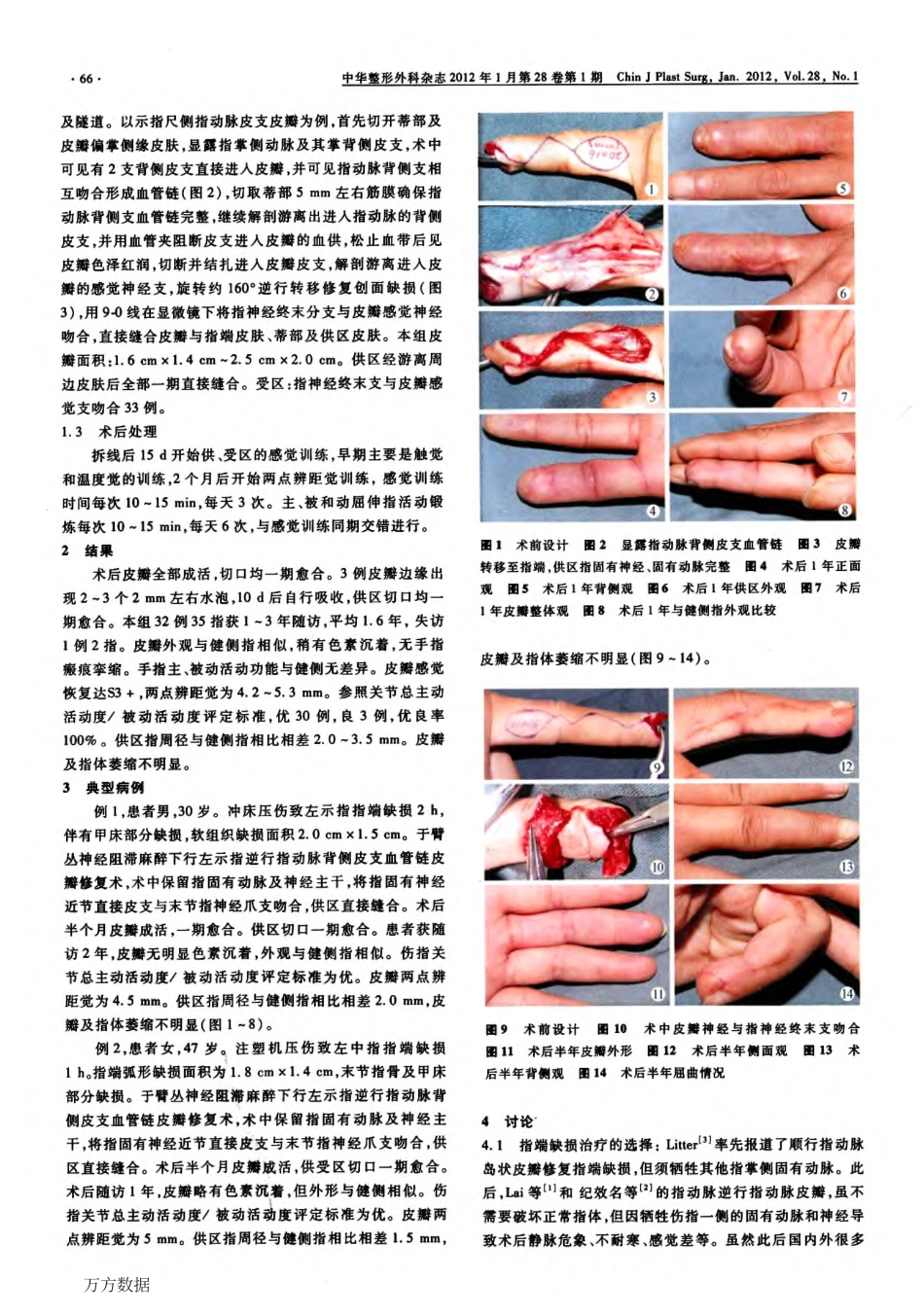 指动脉背侧皮支血管链皮瓣逆行修复指端缺损_第2页