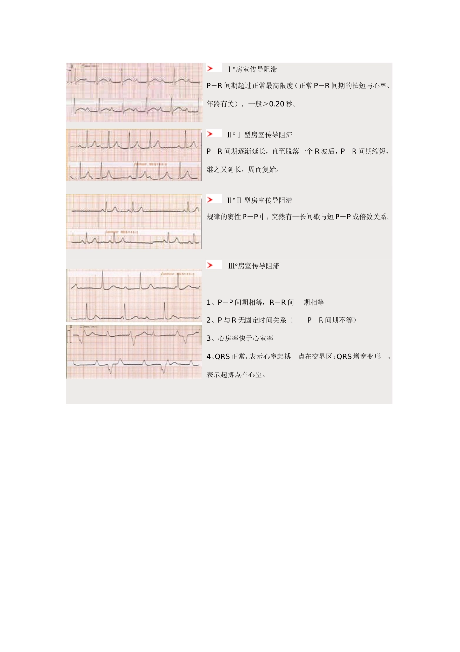 心电图图谱1_第3页