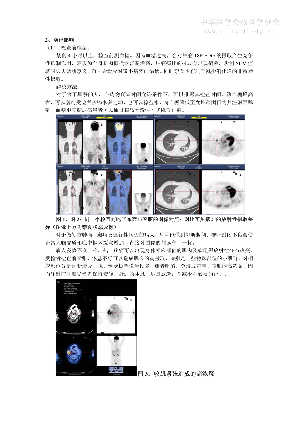 影响PET-CT读片因素_第2页