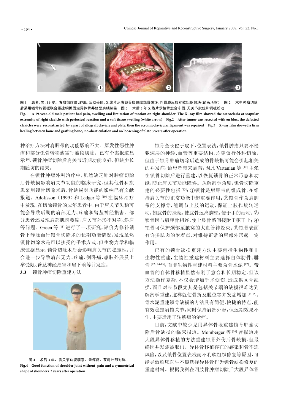 异体锁骨移植重建锁骨肿瘤切除后骨缺损_第3页