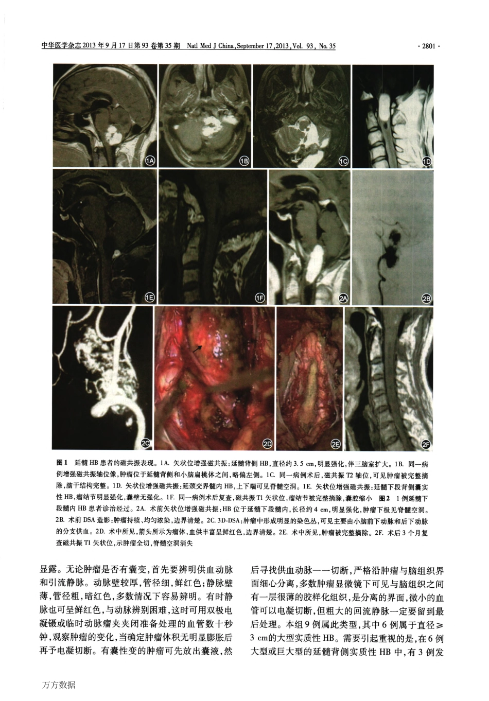 延髓血管母细胞瘤的手术治疗_第3页