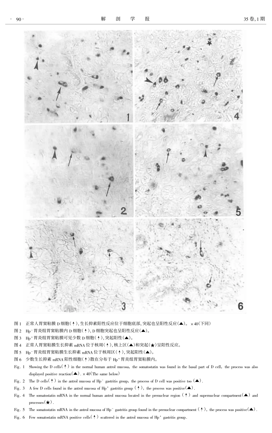 幽门螺旋杆菌对慢性胃炎患者粘膜内D细胞及生长抑素mRNA表达的影响_第3页