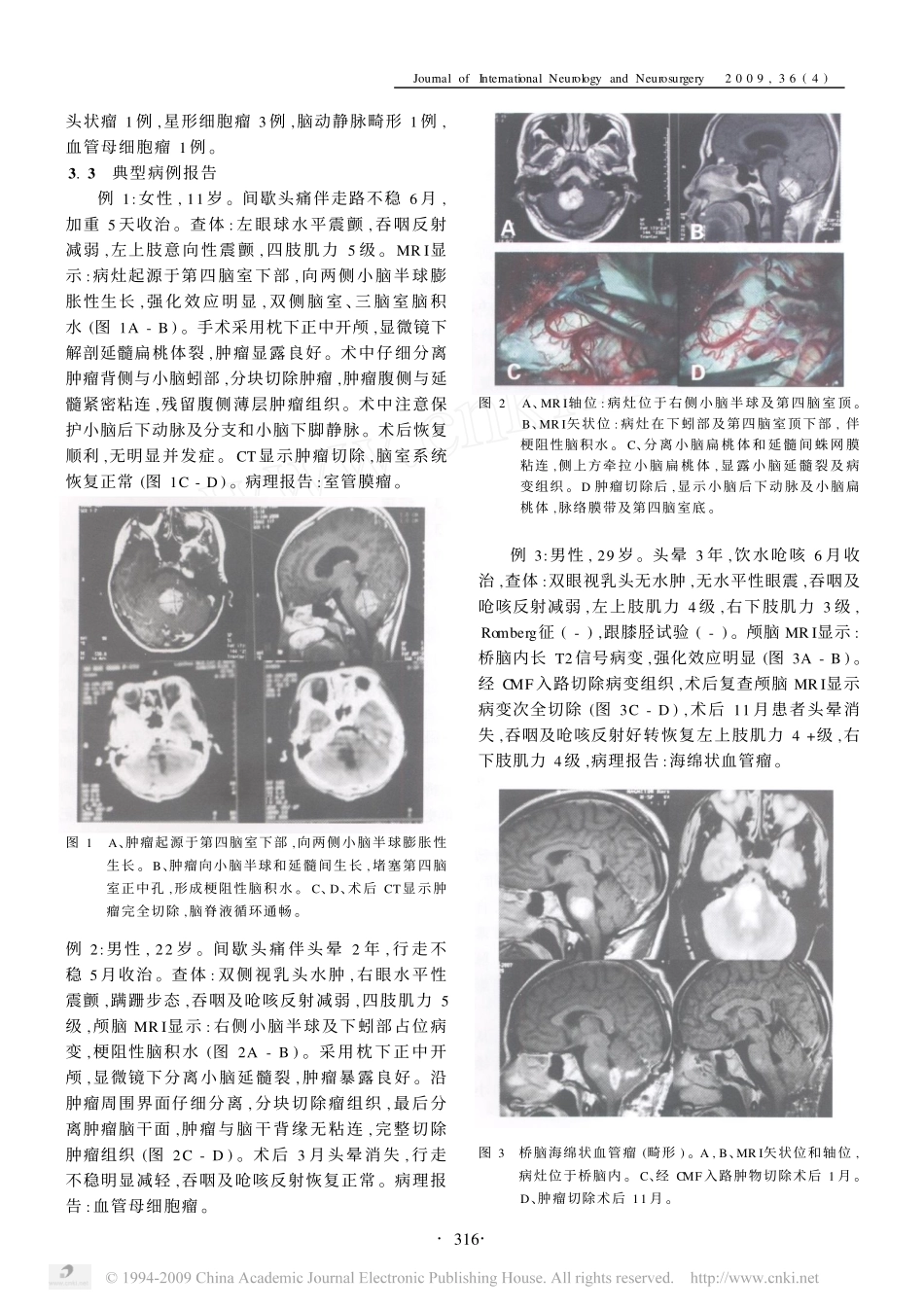 小脑延髓裂入路的临床应用评价_第3页