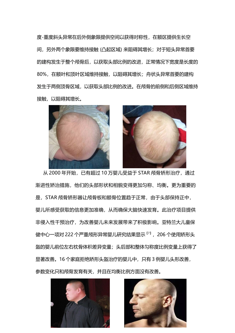 头颅畸形的危害和矫形头盔的作用_第3页
