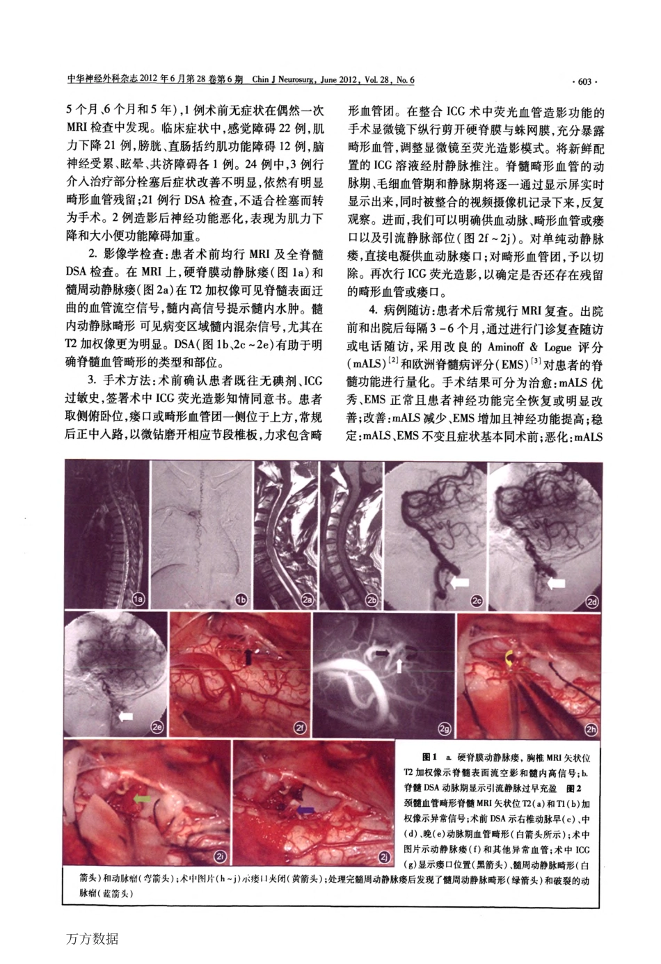 吲哚菁绿术中荧光造影辅助下脊髓血管畸形的手术治疗_第2页