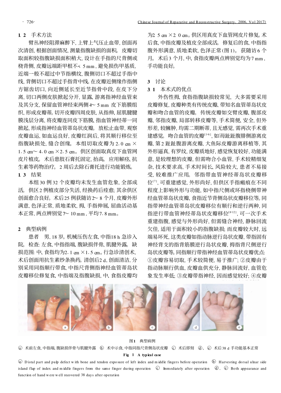 同指顺行岛状皮瓣移位修复指腹缺损_第2页