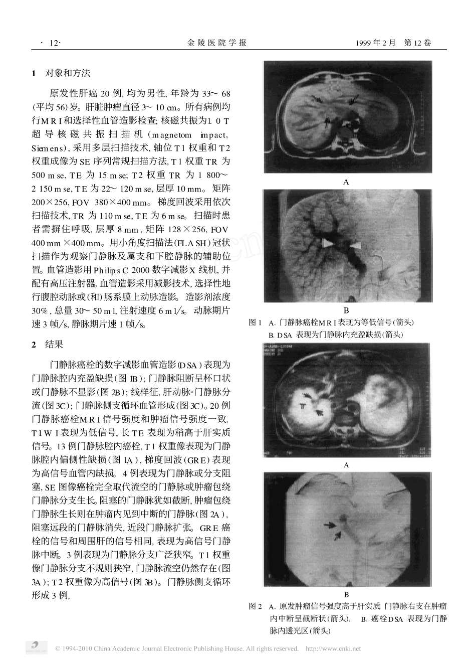 原发性肝癌门静脉癌栓MRI和DSA比较_第2页