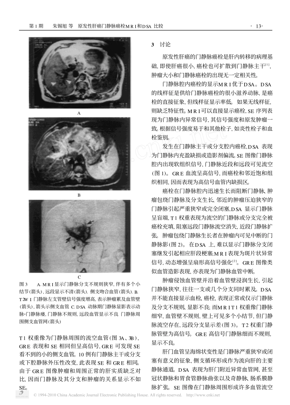 原发性肝癌门静脉癌栓MRI和DSA比较_第3页