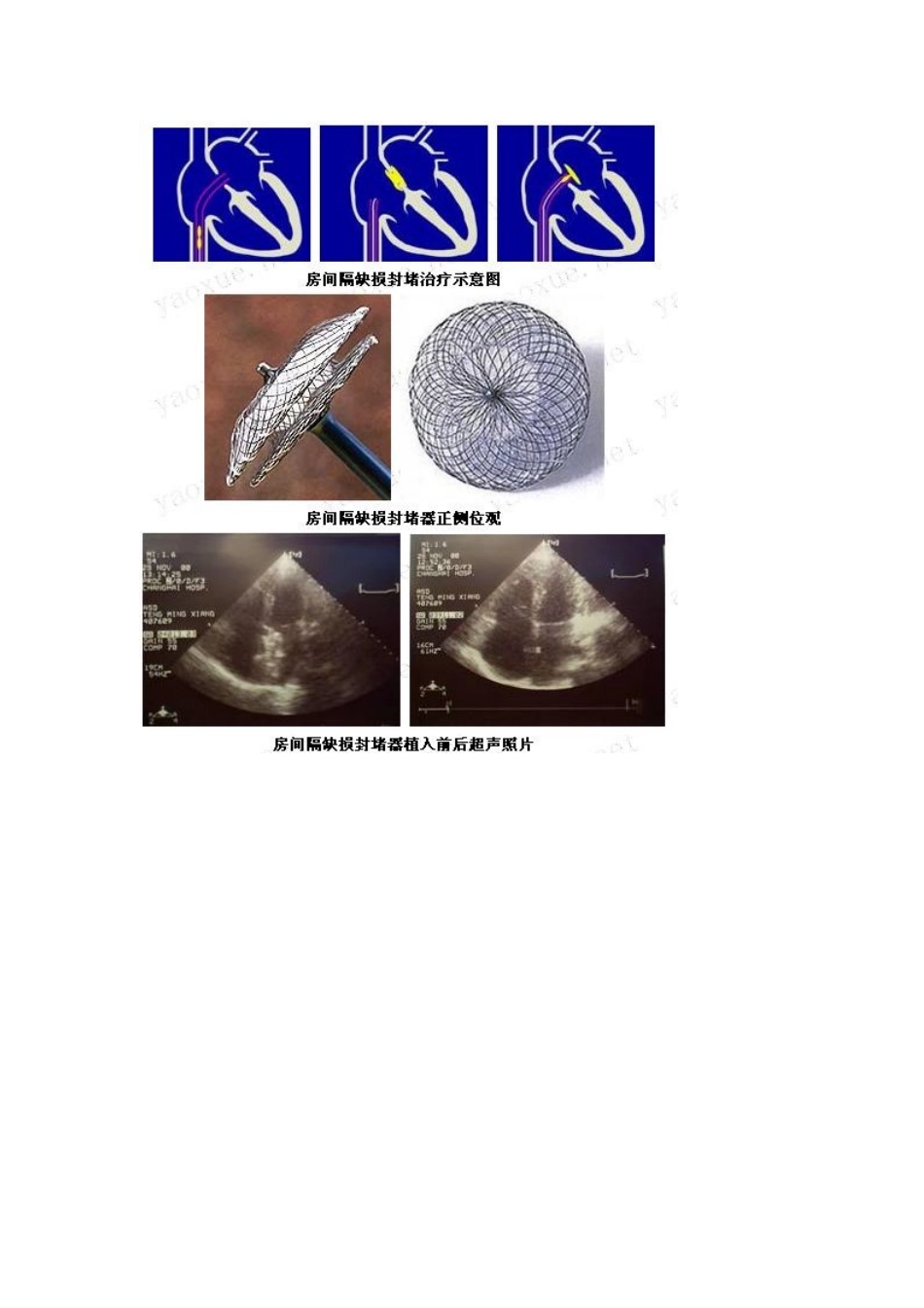 原发性房间隔缺损和正常心脏对照_第2页