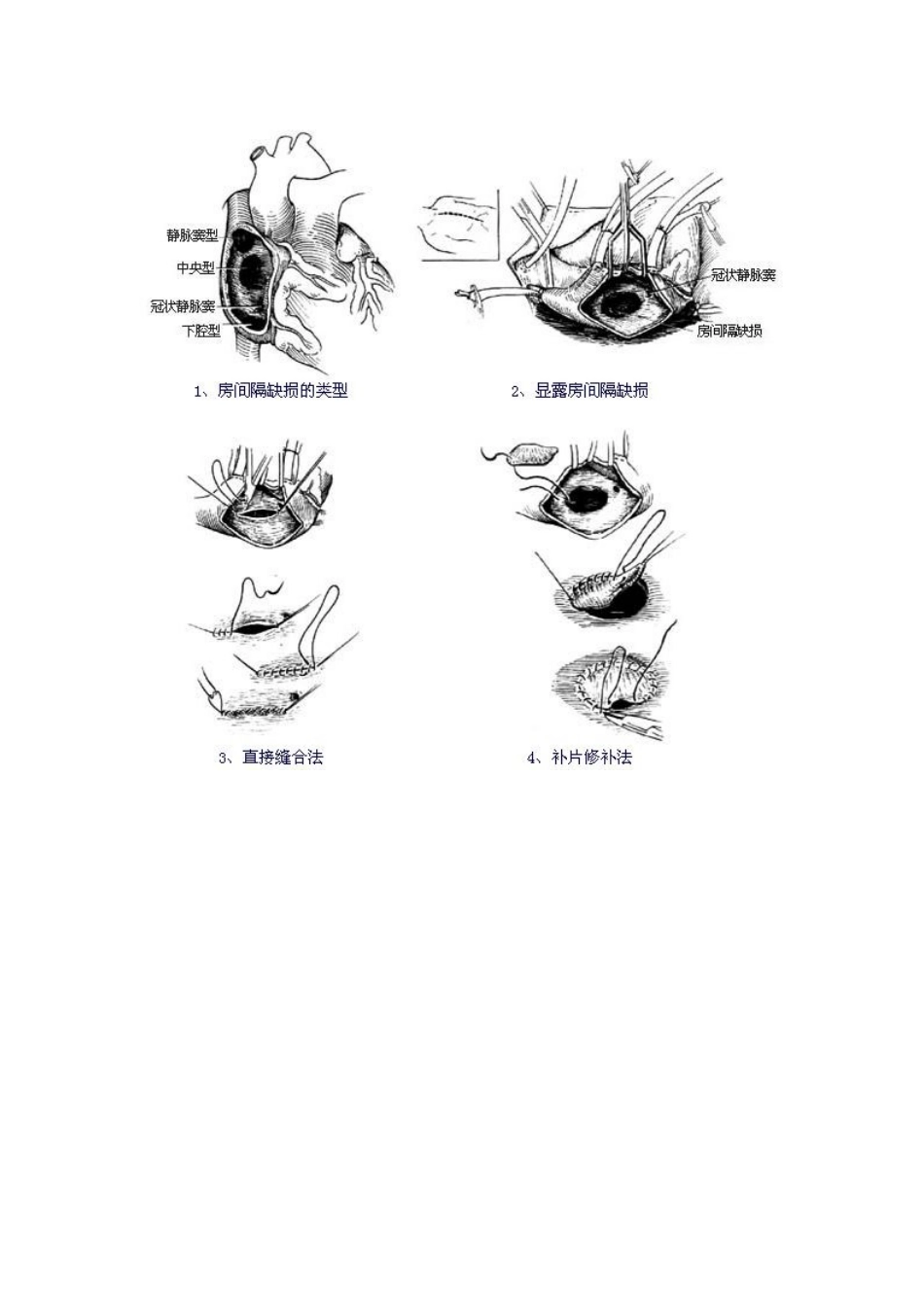原发性房间隔缺损和正常心脏对照_第3页