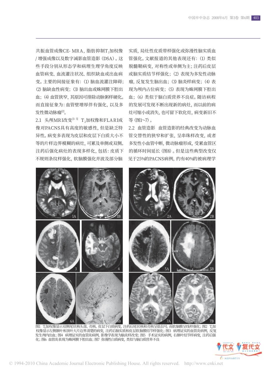 原发性中枢神经系统血管炎的诊断策略_张在强_第2页